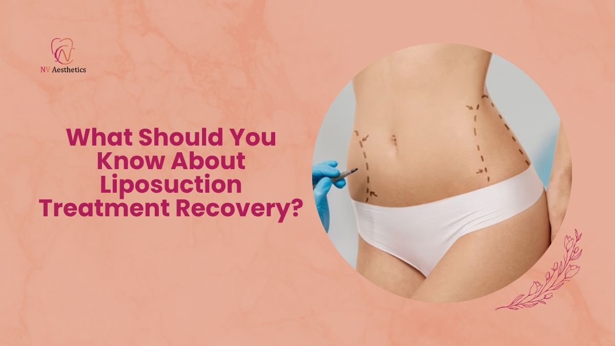 What Should You Know About Liposuction Treatment Recovery?